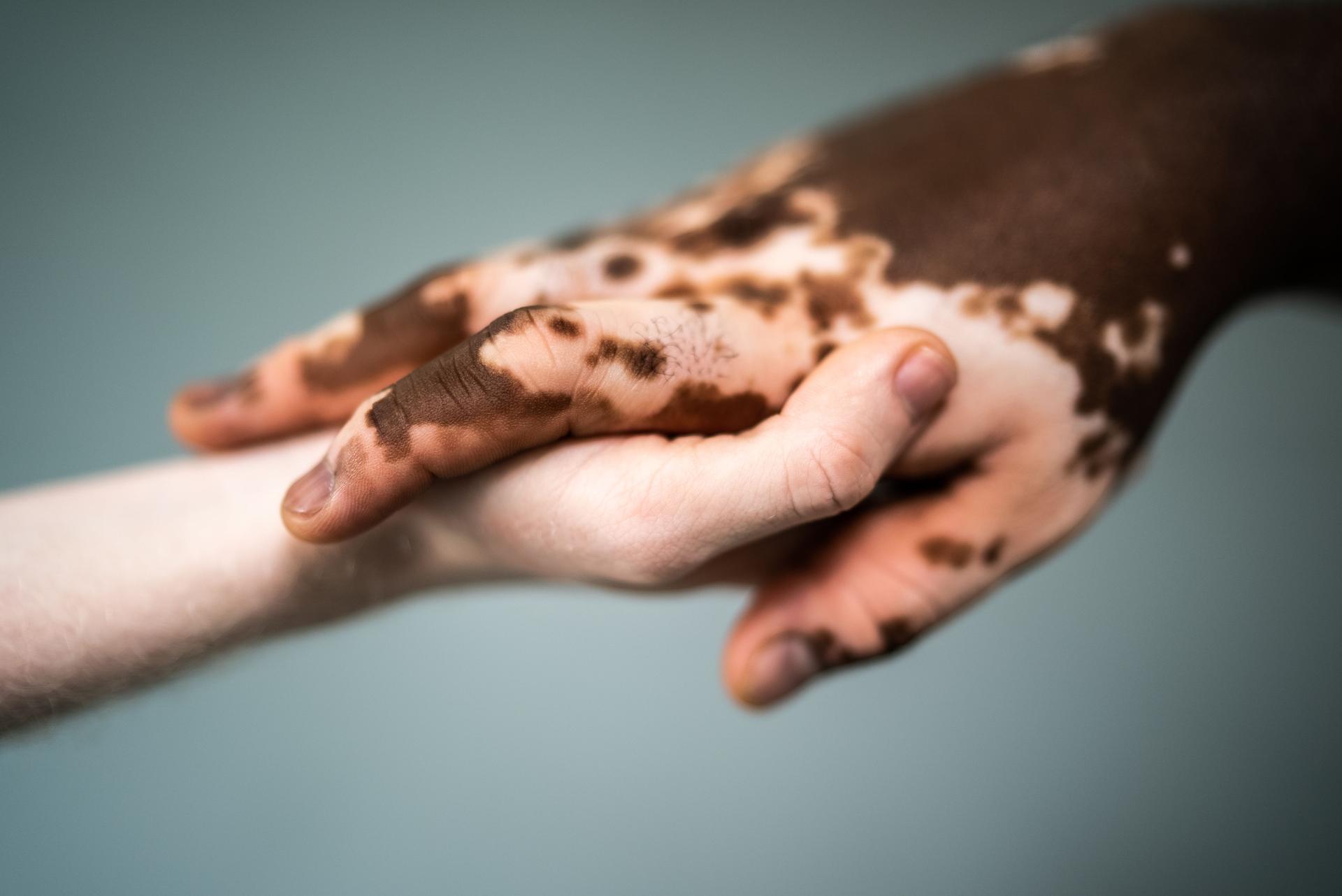 Vitiligo Camouflage 