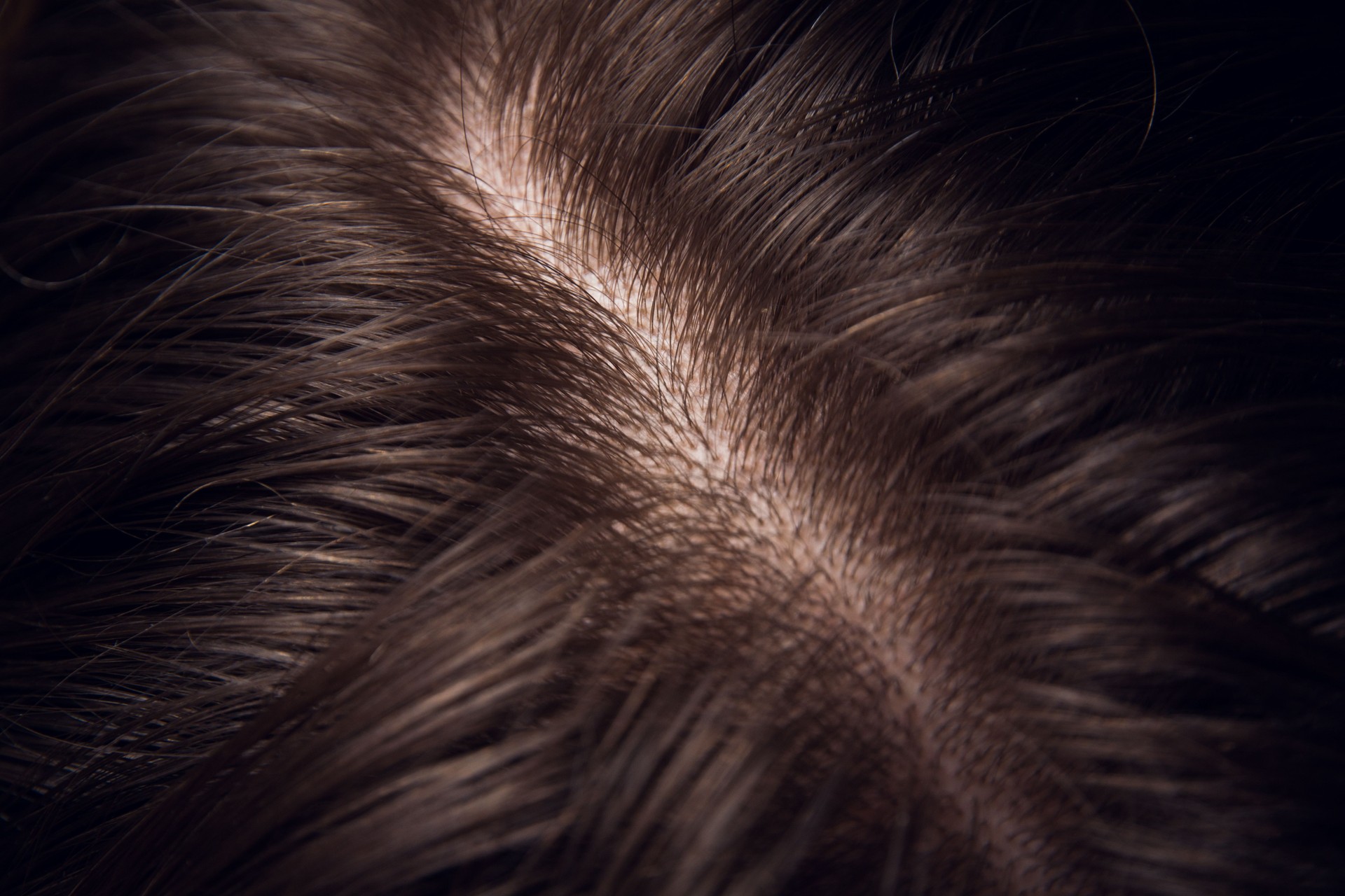 Scalp microPigmentation for women in Bangalore India 