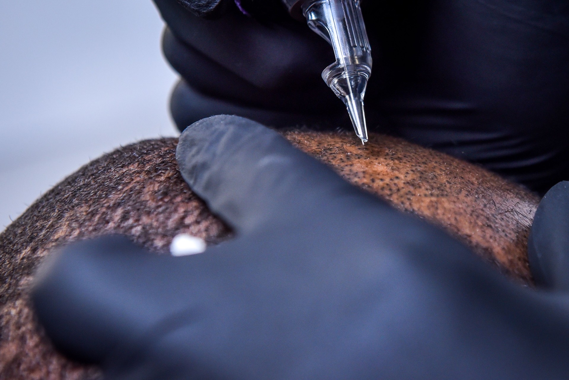 Scalp Micro-pigmentation of bald in Bangalore India